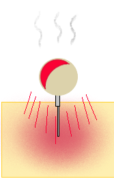 灸頭鍼で肌が熱く赤くなっているイラスト