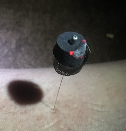 灸頭鍼
鍼の上部についた炭が燃えています