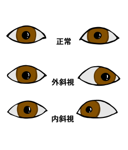 斜視
