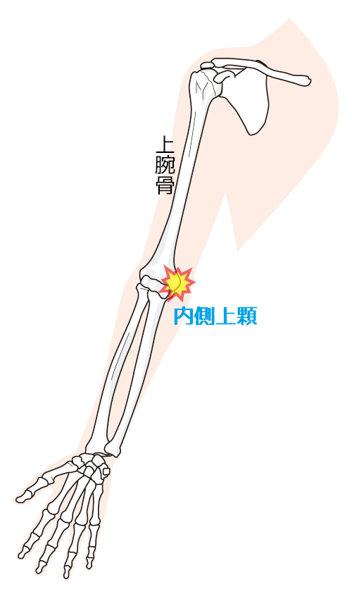 上腕骨外側上顆炎