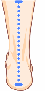 オーバープロネーション