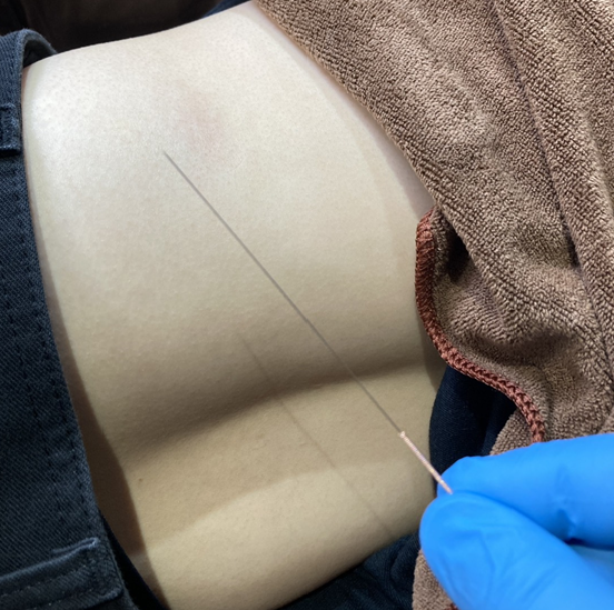 側臥位の腰部を背景に三寸８番の長尺の鍼を指差につまんで見せている